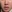 Lip lift (philtrum reduction) — Ua Plastic Surgery Clinic