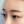 Thread lift — before · Only Lift Clinic