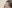 額縮小術（生え際下げ・ヘアライン下降術） — 風が吹く日にも美容外科クリニック