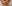 人中短縮（リップリフト） — ドクタータク美容外科クリニック