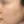 Chemical peel — after (28days) · J.Fill Clinic - Gangnam Branch