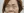 ฟิลเลอร์ใต้ตา (แก้ร่องใต้ตา / ขอบตาคล้ำ) — ก่อนทำ · ไอแบ็ค คลินิก