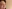 Lower Eyelid Fat Repositioning (transconjunctival) — Hershey Plastic Surgery Clinic