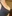 Breast augmentation with implants — Lian Plastic Surgery Clinic
