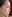 Short nose correction (nose lengthening / derotation) — Coco Line Clinic