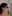 Forehead reduction (hairline lowering surgery) — Uri Plastic Surgery Clinic