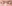 裏ハムラ法（経結膜的眼窩脂肪移動術） — ネイチャーオン美容外科クリニック