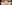 裏ハムラ法（経結膜的眼窩脂肪移動術） — リンク美容外科クリニック