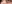 裏ハムラ法（経結膜的眼窩脂肪移動術） — プレジャー美容外科クリニック