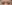 裏ハムラ法（経結膜的眼窩脂肪移動術） — ジャスト美容外科クリニック