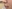 人中短縮（リップリフト） — プランナー美容外科クリニック