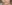 Lip filler (lip augmentation with HA) — Elleve Clinic