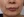JUVGEN (autologous dermal regeneration / collagen-induction injection) — after (14days) · Saeroun Plastic Surgery