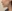Chin reduction (chin bone shaving / narrowing genioplasty) — Uri Plastic Surgery Clinic