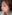 Bulbous nose correction (surgical nasal tip reduction) — Eight Plastic Surgery Clinic