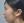 Oligio / Oligio X (โอลิจิโอ) — ก่อนทำ (30วัน) · คลินิกศัลยกรรมพลาสติก LaVian