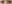 涙袋形成（脂肪注入） — ファクト美容外科クリニック