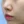 Chemical peel — before (28days) · J.Fill Clinic - Gangnam Branch