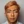 Ultracol (PDO microsphere collagen stimulator injection) — after (3days) · Project U Clinic