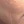 PRP skin rejuvenation (platelet-rich plasma therapy) — before (21days) · Only Lift Clinic