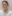 Lower Eyelid Fat Repositioning (transconjunctival) — Uri Plastic Surgery Clinic