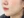 童颜针（舒颜萃/Sculptra）法令纹 — 术后 (30天) · Monster诊所
