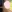Double chin liposuction (submental liposuction) — Yuno Plastic Surgery