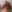Double chin liposuction (submental liposuction) — Seoul During Clinic