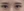 incisional double eyelid surgery — after (7days) · iLumi Plastic Surgery Clinic