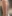 二の腕の脂肪溶解注射 — ロリポップ美容外科クリニック