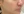 skin booster injection (water glow injection) — before (5days) · Nowon ID Clinic