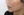 ตัดไขมันกระพุ้งแก้ม — หลังทำ (9วัน) · ไอรูมิ ศัลยกรรมพลาสติก