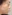 鼻尖形成術（自家軟骨移植） — マーブル美容外科クリニック