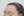 Forehead reduction (hairline lowering surgery) — before (9days) · Goyu Plastic Surgery Clinic