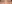 裏ハムラ法（経結膜的眼窩脂肪移動術） — プレジャー美容外科クリニック