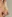 Nasal Tip Plasty with Autologous Cartilage — Uri Plastic Surgery Clinic