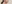 Double chin liposuction (submental liposuction) — Seoul During Clinic