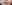 人中短縮（リップリフト） — ハイボム美容外科クリニック