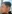 jaw angle reduction (mandibular angle osteotomy) — Uri Plastic Surgery Clinic
