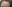 額縮小術（生え際下げ・ヘアライン下降術） — ザフィックス美容外科クリニック