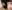 buried suture (non-incisional) double eyelid surgery — 1mm Plastic Surgery