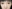 revision eyelid surgery (secondary blepharoplasty) — Luho Plastic Surgery Clinic