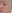 Rejuran Healer (salmon-DNA polynucleotide / PN skin booster) — Project U Clinic