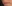 人中短縮（リップリフト） — ドクタータク美容外科クリニック