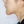 ศัลยกรรมลดขนาดคาง (กรอ/ตัดกระดูกคาง) — ก่อนทำ (14วัน) · คลินิกเอเคศัลยกรรมพลาสติก