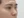 Nasal tip augmentation with implant — before (7days) · The Ollim Plastic Surgery Clinic