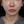 Density Lifting (RF skin tightening / lifting) — after · Ripain Clinic