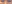 裏ハムラ法（経結膜的眼窩脂肪移動術） — プレジャー美容外科クリニック