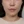 Ultraformer III (อัลตร้าฟอร์เมอร์) — หลังทำ · คลินิกรีไฟน์