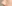 鼻尖形成術（自家軟骨移植） — ルホ美容外科クリニック